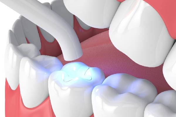 Dental Restoration
